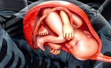 ALÔ DOUTOR: IMPORTANTE SABER sobre Circulares do Cordão Umbilical